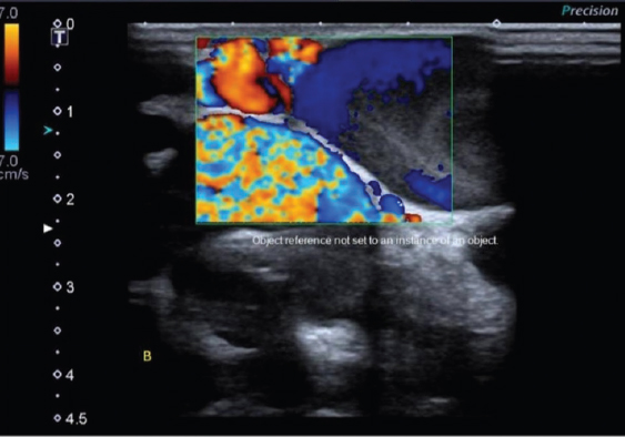 Ultrasound image showing multiple tortuous dilated vascular channels with aliasing effect – high-flow vascular malformation.